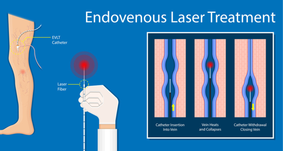 Endovenous Laser Treatment