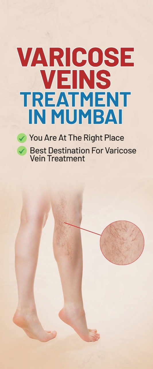 Varicose Vein