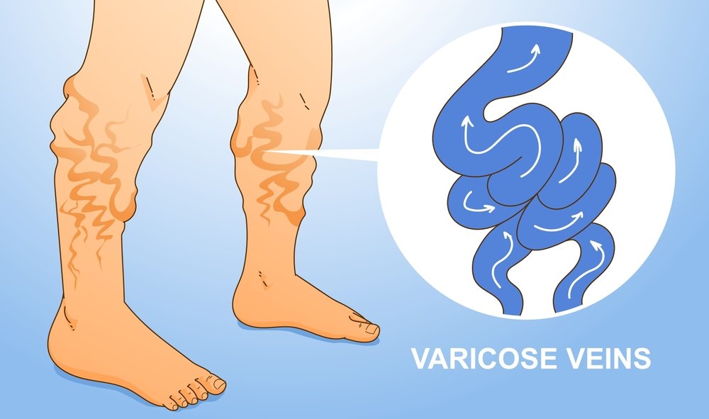 Human,Legs,With,Health,Problems.,Varicose,Veins.,Vector,Illustration.,Healthcare