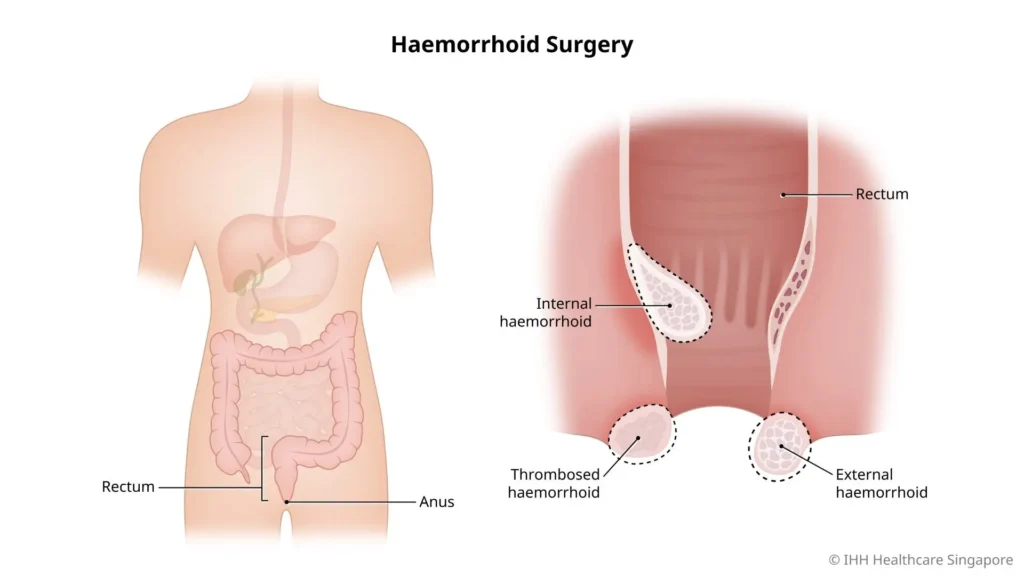 haemorrhoid